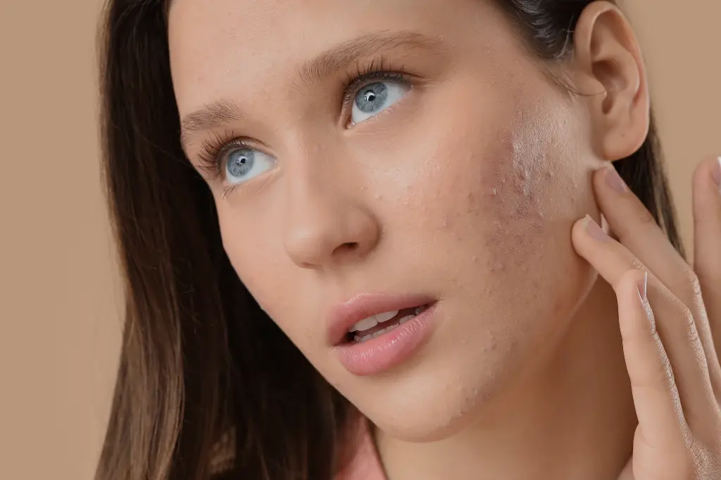 Facial pimples