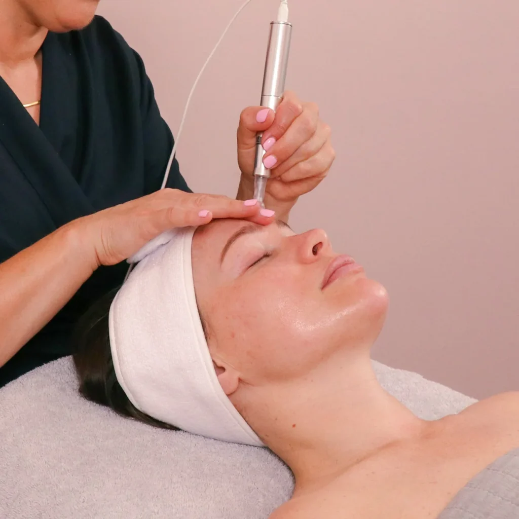 Microneedling procedure