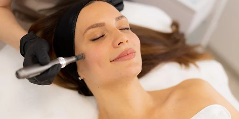 Microneedling session 3
