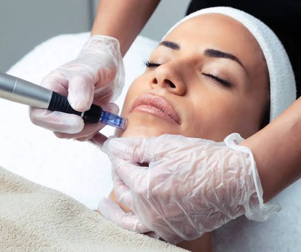 Microneedling treatment