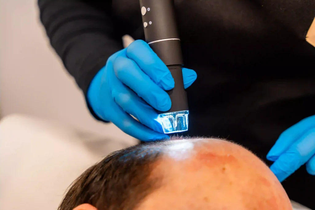 Man at the spa getting an baldness treatment with 2026 03 17 17 49 51 utc