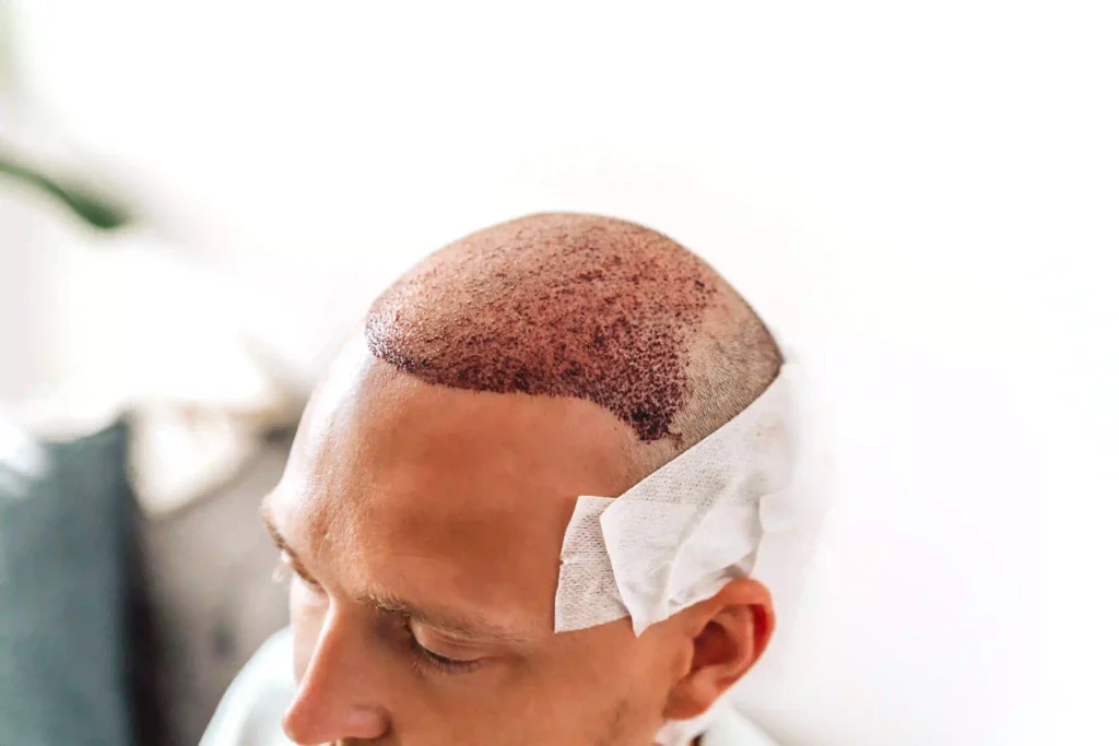 Man recovering after hair transplant procedure 2026 03 15 23 25 13 utc