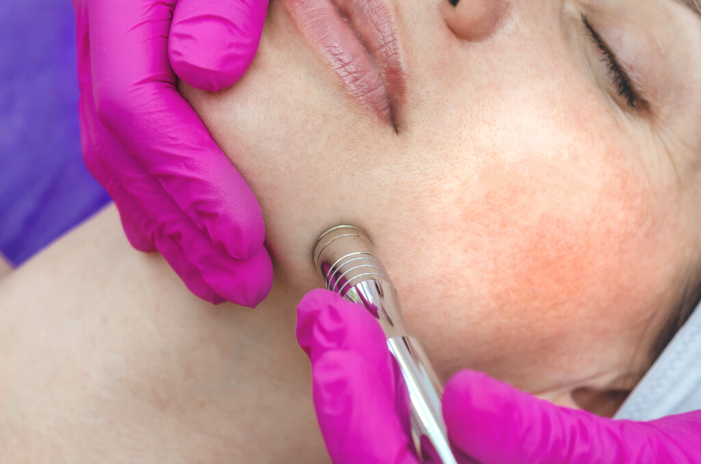 Microdermabrasion
